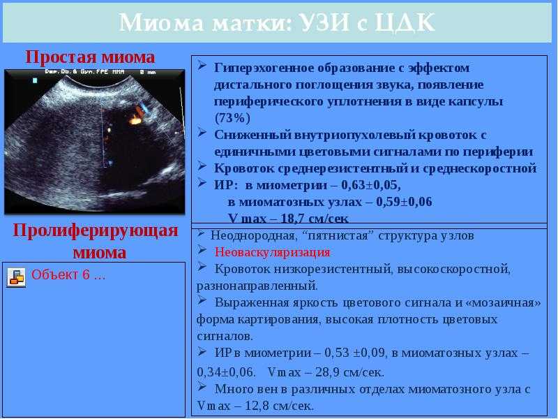 Миома матки - симптомы, причины, диагностика, лечение в левита