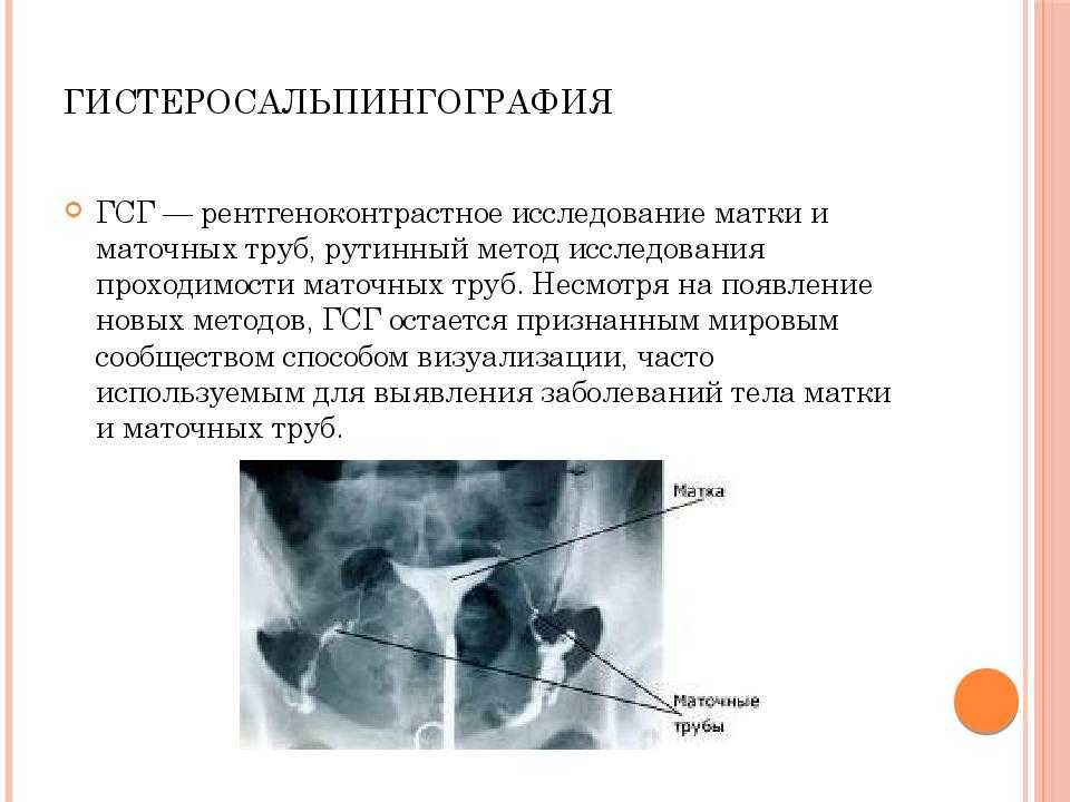 ГСГ – метод диагностического обследования матки и маточных труб при помощи рентгеноконтрастных препаратов Проведение ГСГ показано при подозрении на трубный фактор бесплодия, на подслизистую миому матки, полипы, рак эндометрия, спаечные процессы в матке и