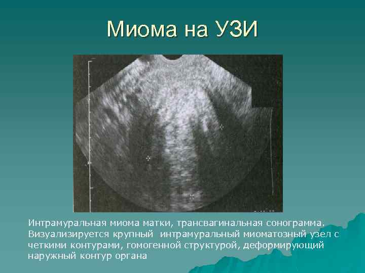 Эндометрия узлов. Интрамуральная миома на УЗИ. Субмукозная миома матки УЗИ.