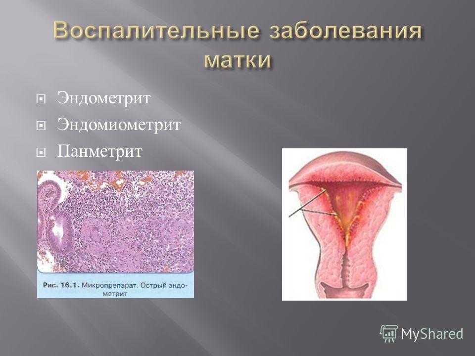 Воспаление внутренней оболочки матки. Метроэндометрит и эндометрит. Эндоцервицит, эндометрит. Септический эндометрит патанатомия.