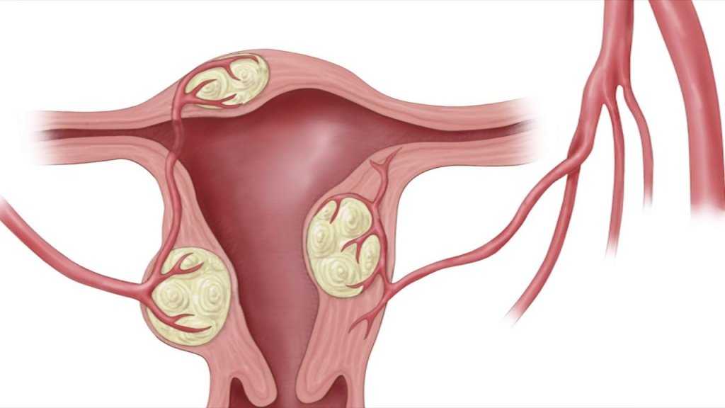 Подслизистая лейомиома матки что это