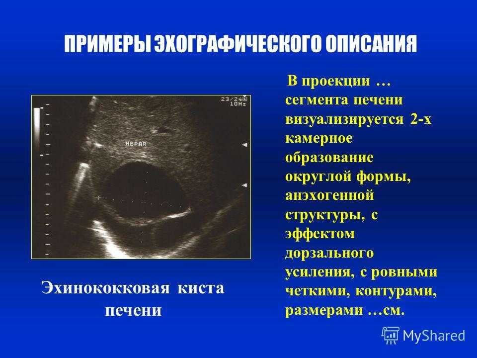 Эхографическое изображение злокачественной опухоли чаще представляет собой образование