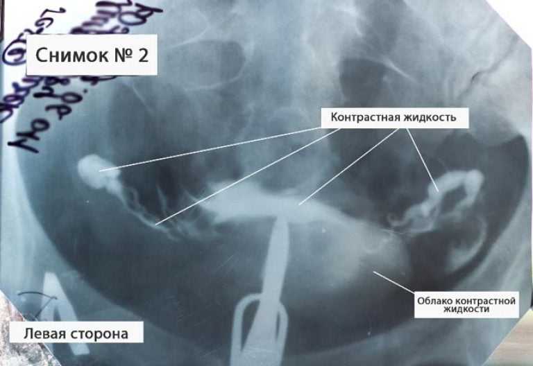 Как делают рентген маточных труб
