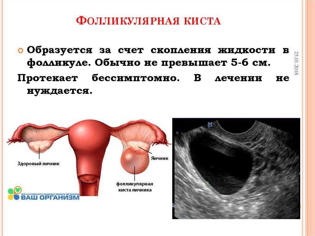 Киста яичника: как выявить и вылечить опасное образование