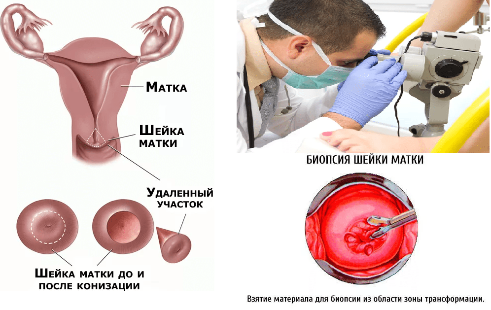 Радиоволновая биопсия шейки матки фото