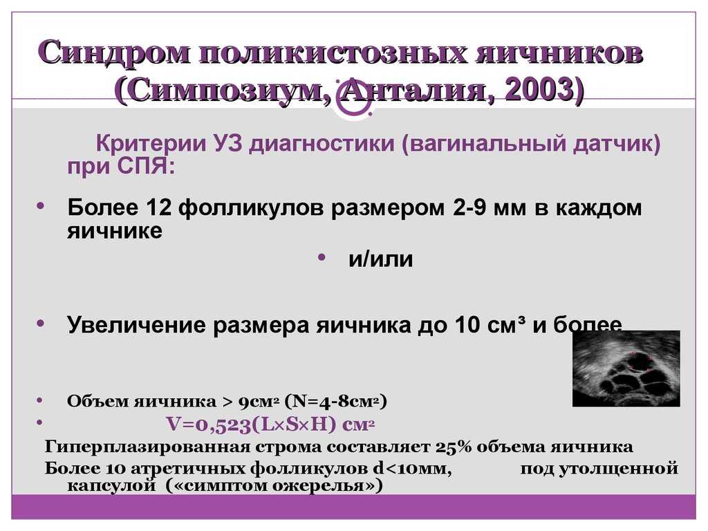 Синдром поликистозных яичников