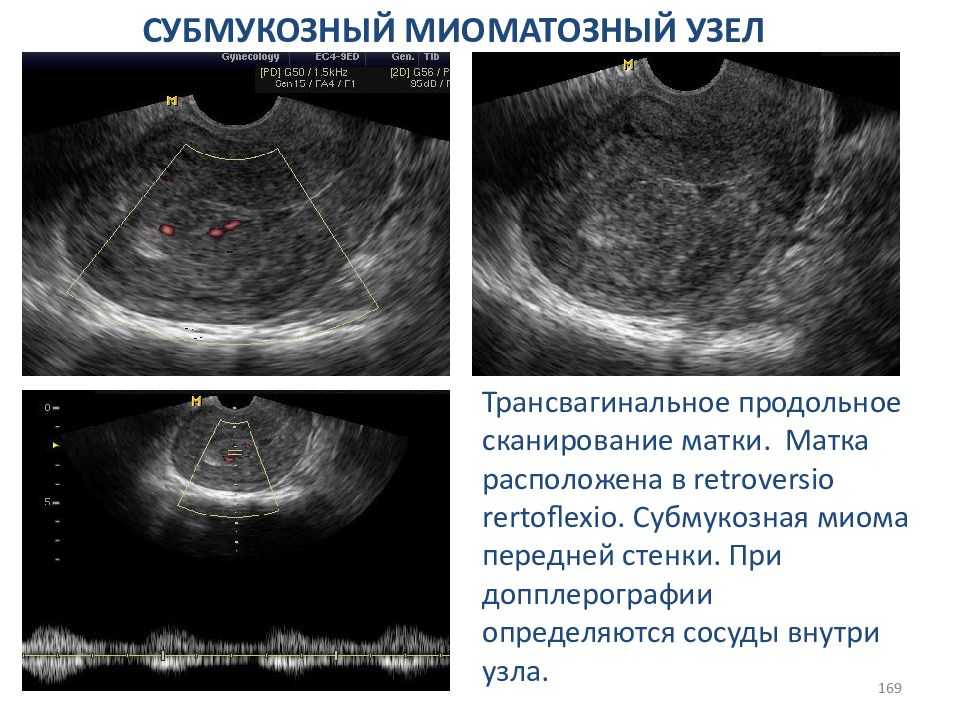 Какой эндометрий нужен. Подслизистый миоматозный узел УЗИ. Миоматозный узел матки на УЗИ. УЗИ признаки миомы тела матки.