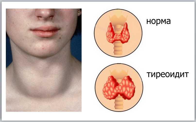 Заболевания щитовидной железы – лечение, причины, диагностика. гкб №71