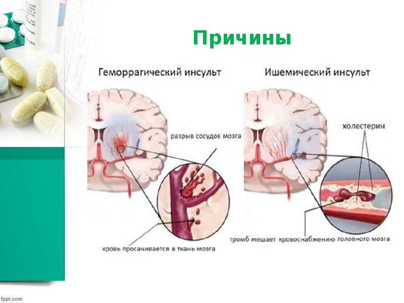 Геморрагический инсульт презентация