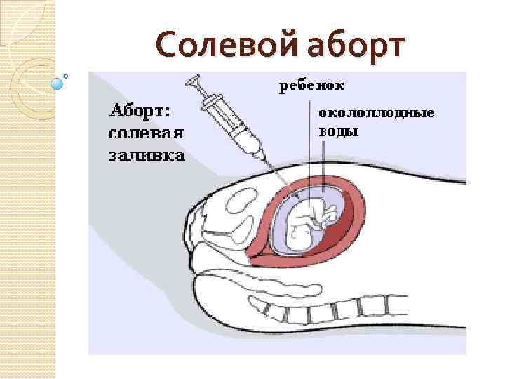 Какой аборт лучше: медикаментозный, мини или хирургический