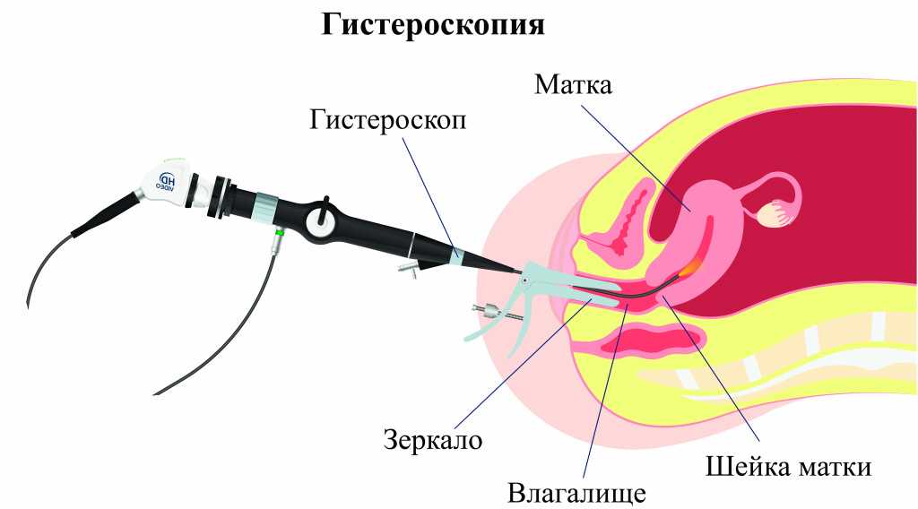 Гистероскопия: показания, подготовка, осложнения