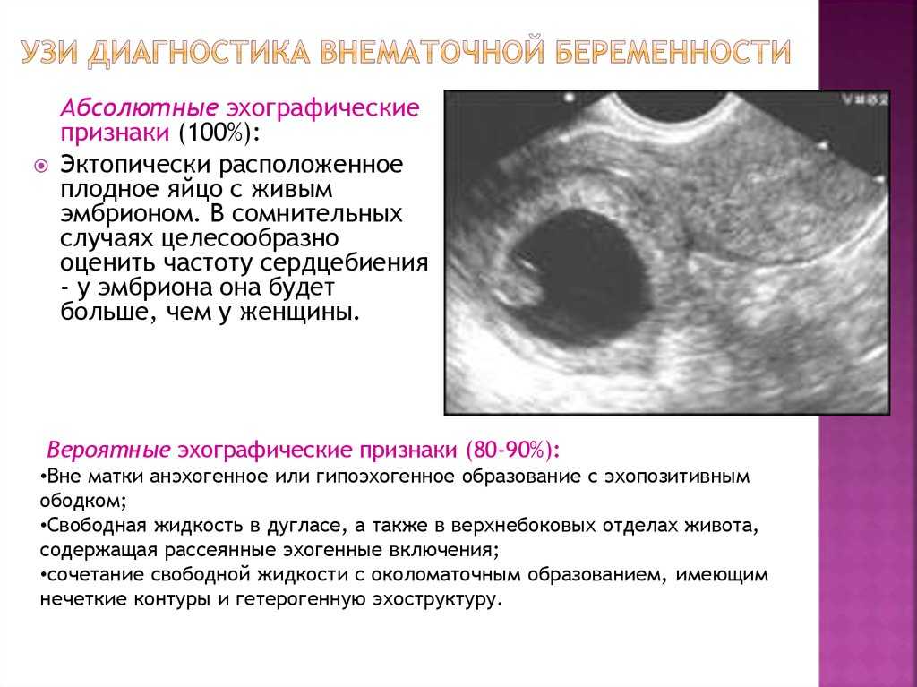 Внематочная беременность: признаки на ранних сроках