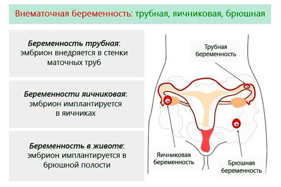 Причины внематочной беременности | eurolab | гинекология