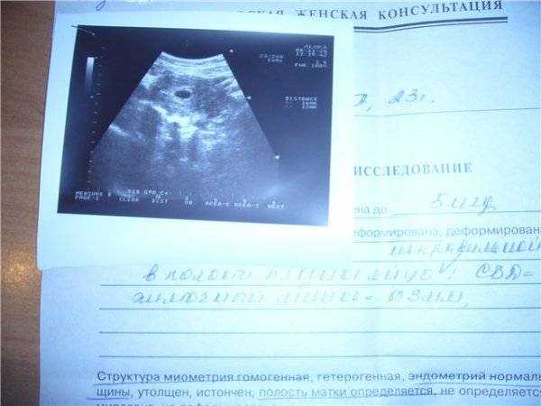 Причины и симптомы неразвивающейся беременности