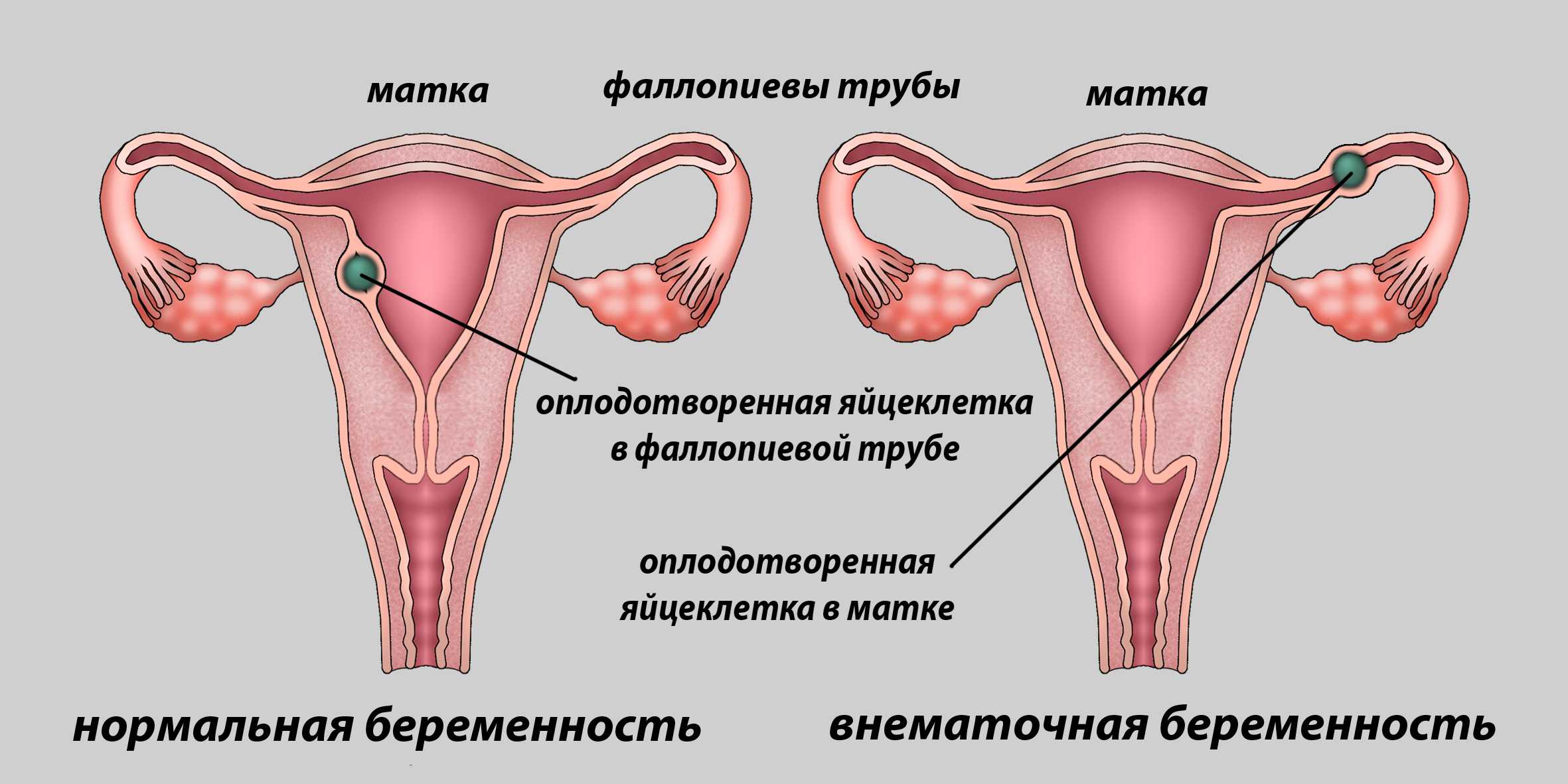 Реабилитация после внематочной беременности – это поиск причины осложненной беременности и ее лечение Ответственное отношение к своему здоровью во время реабилитации поможет женщине стать матерью