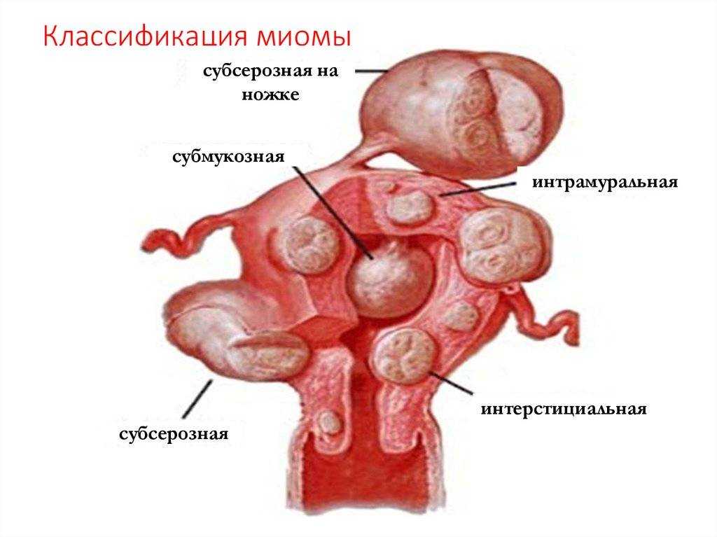Миома на задней стенке матки. Субмукозная миома классификация. Субмукозная миома матки классификация. Интерстициальная миома матки симптомы. Интерстициальная миома матки малых размеров что это.