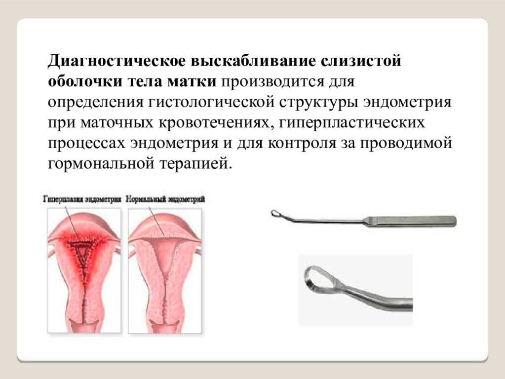 Чистка эндометрия при эндометрии матки. Раздельное (фракционное) диагностическое выскабливание. Инструментальная ревизия полости матки. Выскабливание слизистой оболочки. Выскабливание полости матки инструментарий.