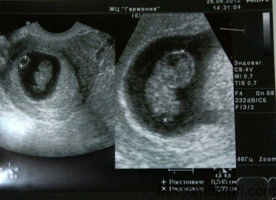 Ребенок на 8 неделе беременности фото