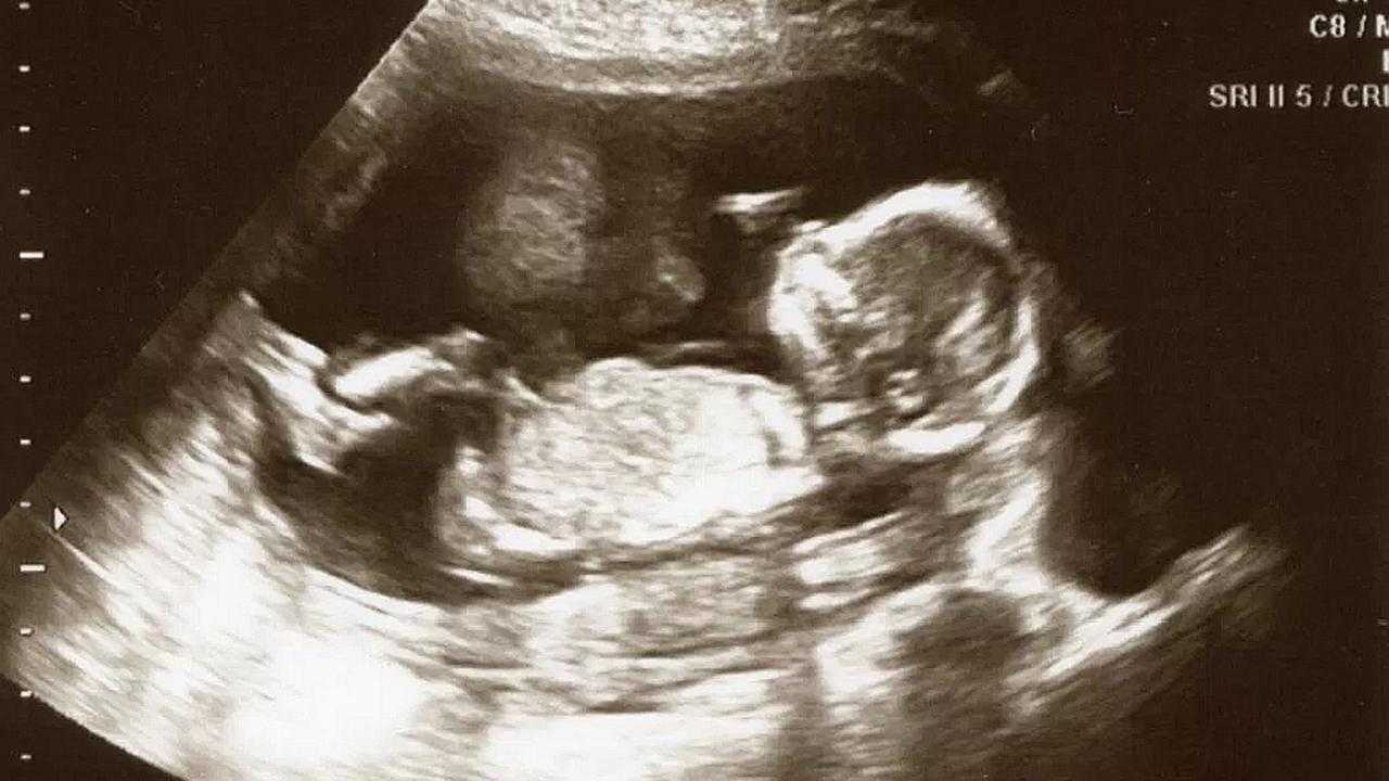 На узи 16 недель беременности фото узи