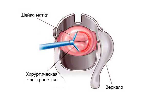 Эксцизия это. Электроэксцизия конизация шейки матки. Колонизация дисплазии шейки. Петлевая электроэксцизия шейки.