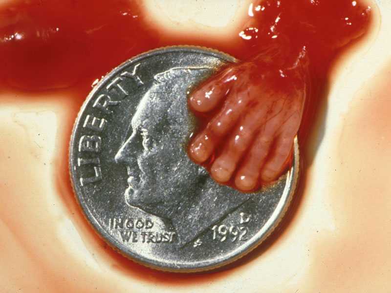 Аборт на большом сроке | последствия, медикаментозный аборт