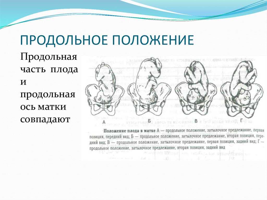 Тазовое предлежание презентация