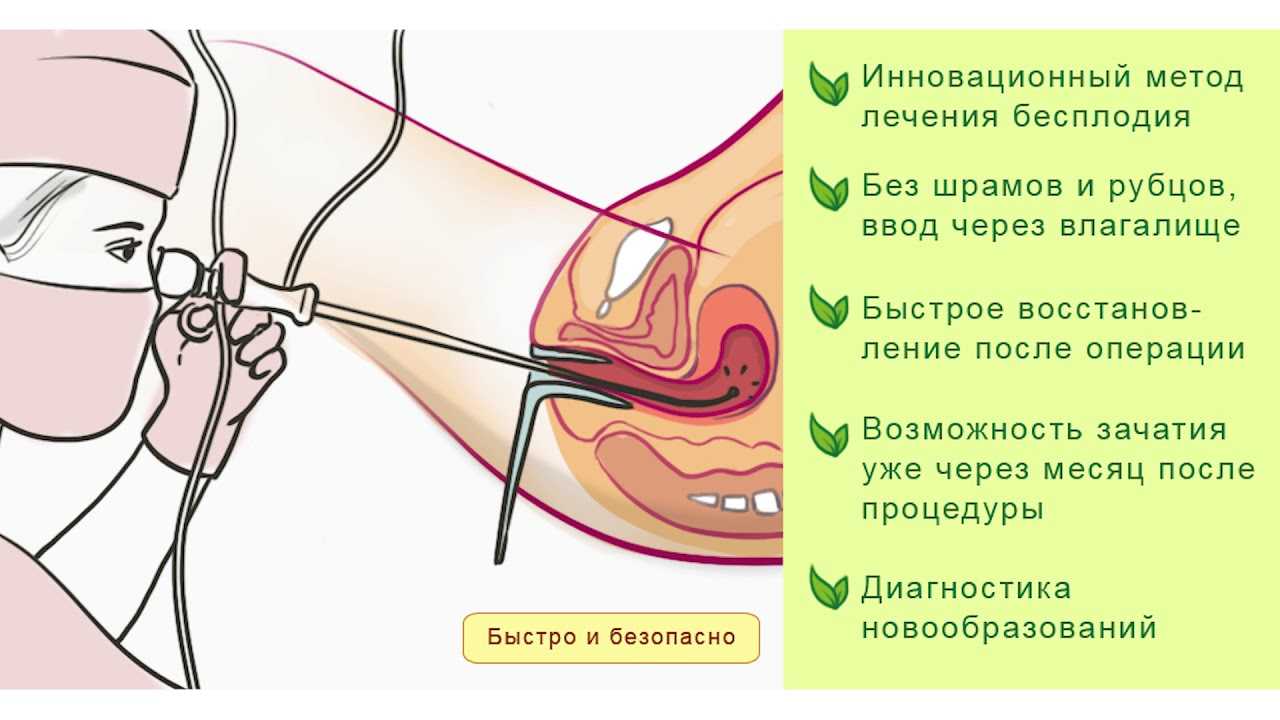 Гистероскопия методика