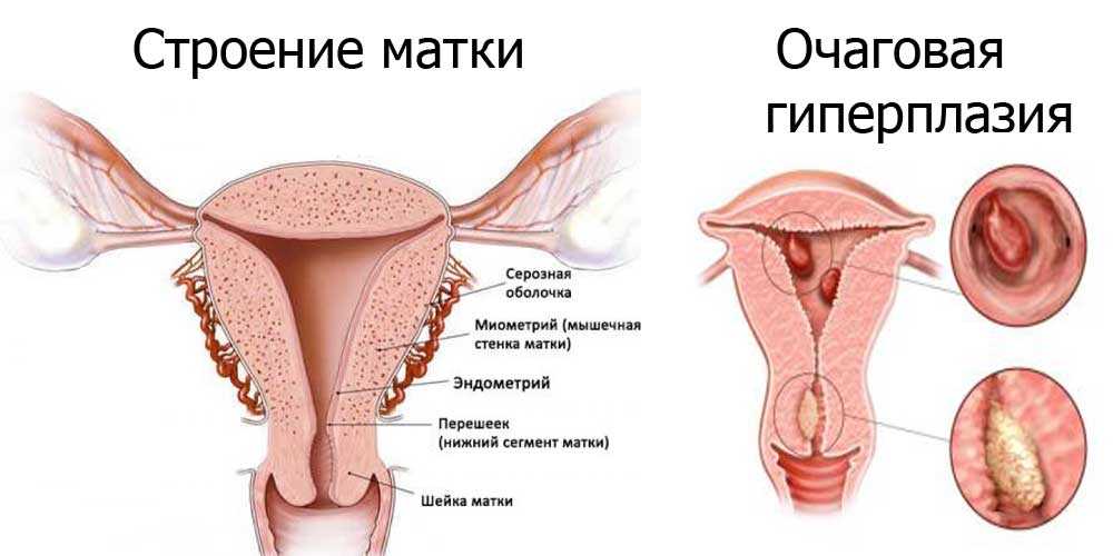 Разрастается эндометрий. Очаговая гиперплазия эндометрия матки что это. Разрастание слизистой матки. Очаговая гиперплазия эндометрит. Очаговая гиперплазия эндометрия полипа.