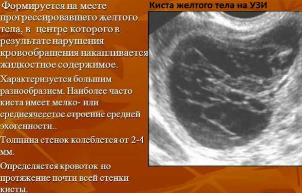 Опухоль матки: причины, симптомы, виды