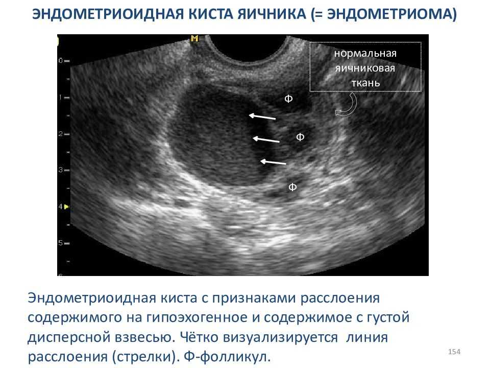 Как выглядит рак яичника на узи у женщин фото