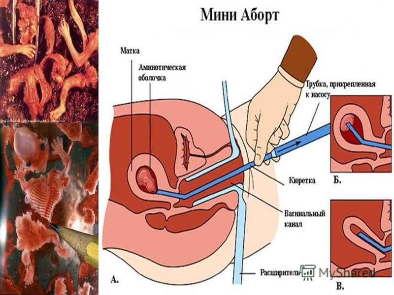 Бесплодие как последствие аборта – велик ли риск?