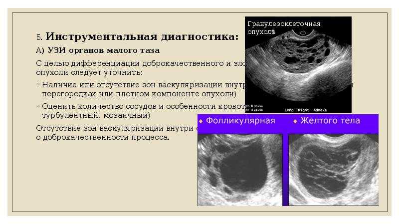 Киста яичника - симптомы, фото на узи, что делать
