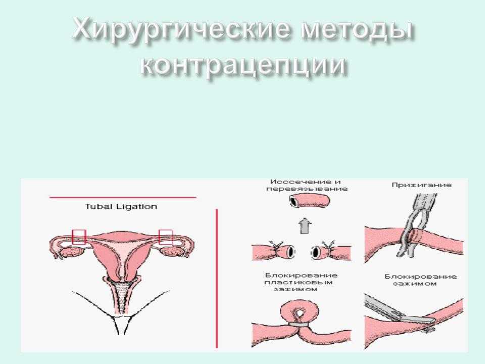 Как перевязывают трубы у женщин. Хирургическая стерилизация маточных труб. Хирургическая стерилизация по Мадленеру.