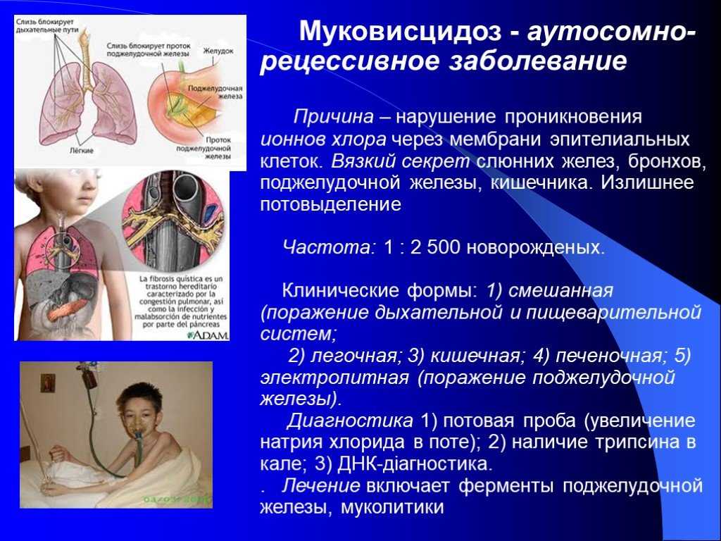 Муковисцидоз