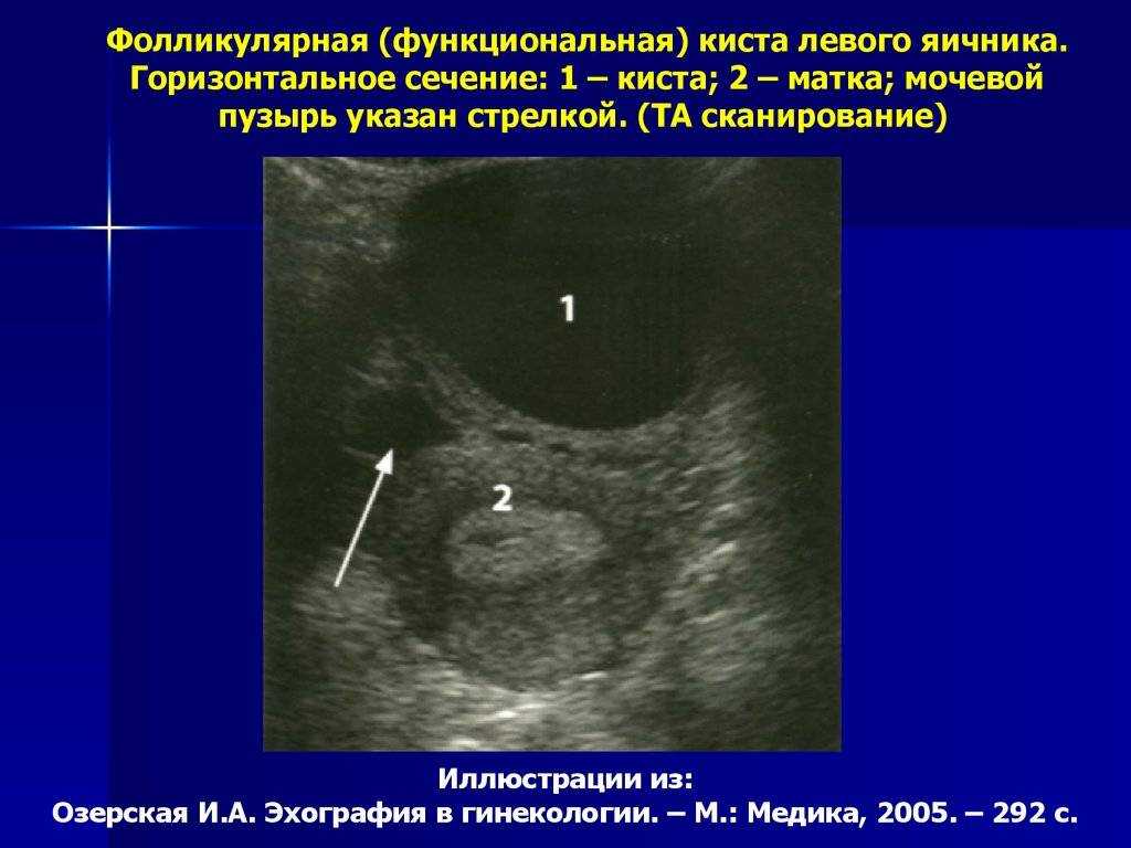 Гормональная киста яичника схема лечения