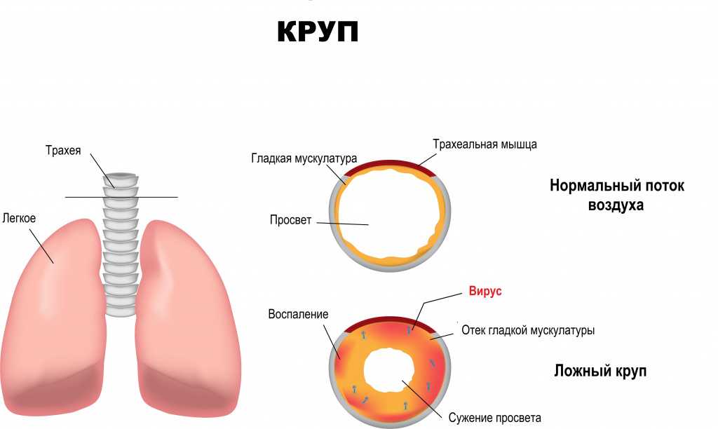 Трахеит. причины, симптомы, диагностика и лечение болезни. профилактика и эффективное лечение трахеита у детей и взрослых.