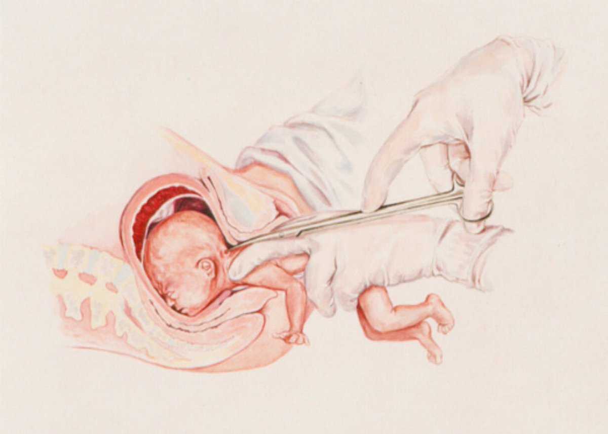 Прерывание беременности на поздних сроках (аборт): срок, показания, способы, методы