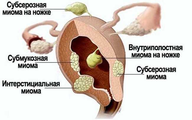 Миома матки: симптомы и методы диагностики. консервативное и хирургическое лечение миомы матки