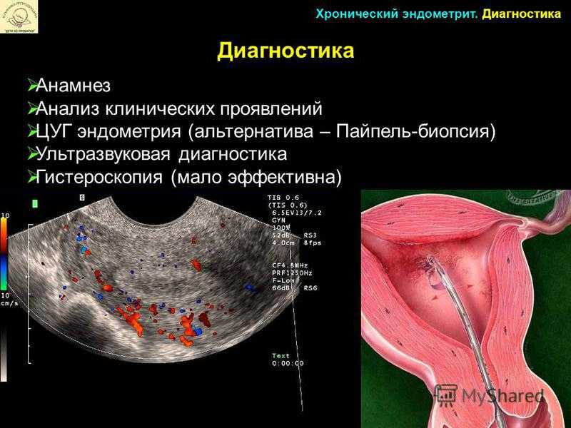 Эндометрий цервикального канала