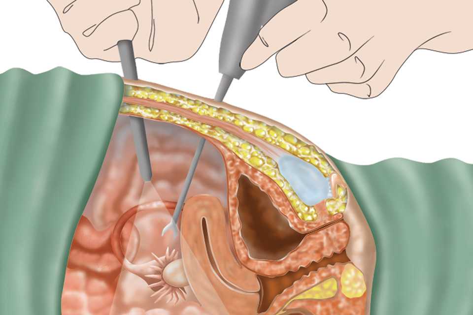 Микрохирургическая пластика маточных труб при бесплодии