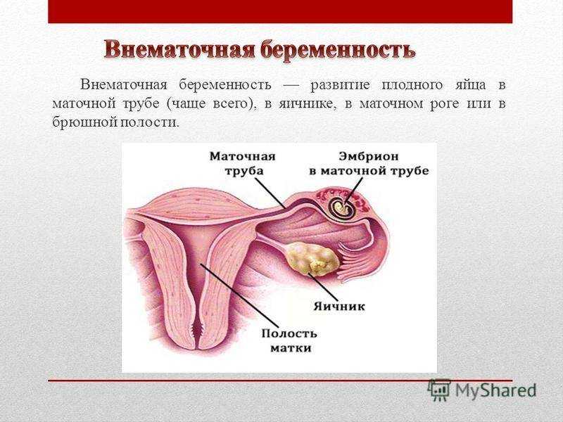 Маточная беременность. Внематочная беременность. Внематочная беременность операция. Причины внематочной беременности.