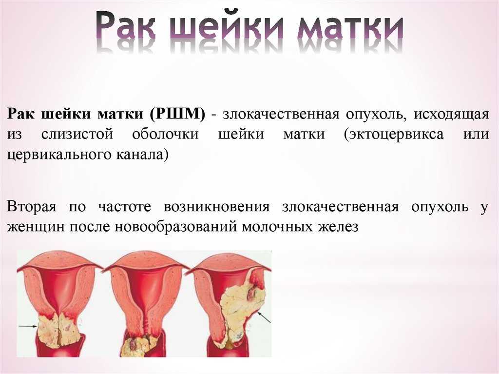 Гипертрофическое удлинение шейки матки — крест на половой жизни * клиника диана в санкт-петербурге