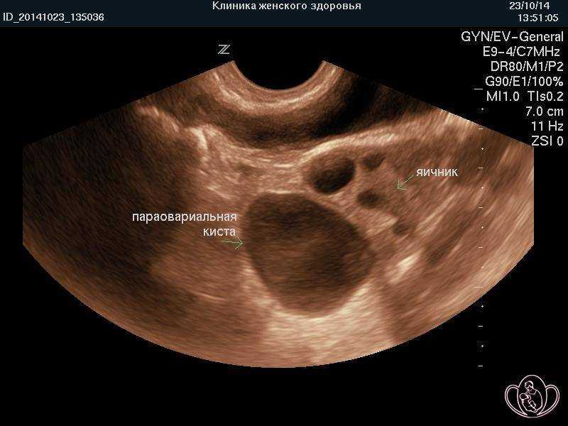 Как выглядит яичник. Параовариальная киста на УЗИ яичника. Параовариальная киста яичника 10мм. Фолликулярная киста яичника на УЗИ. Фолликулярная киста на УЗИ.