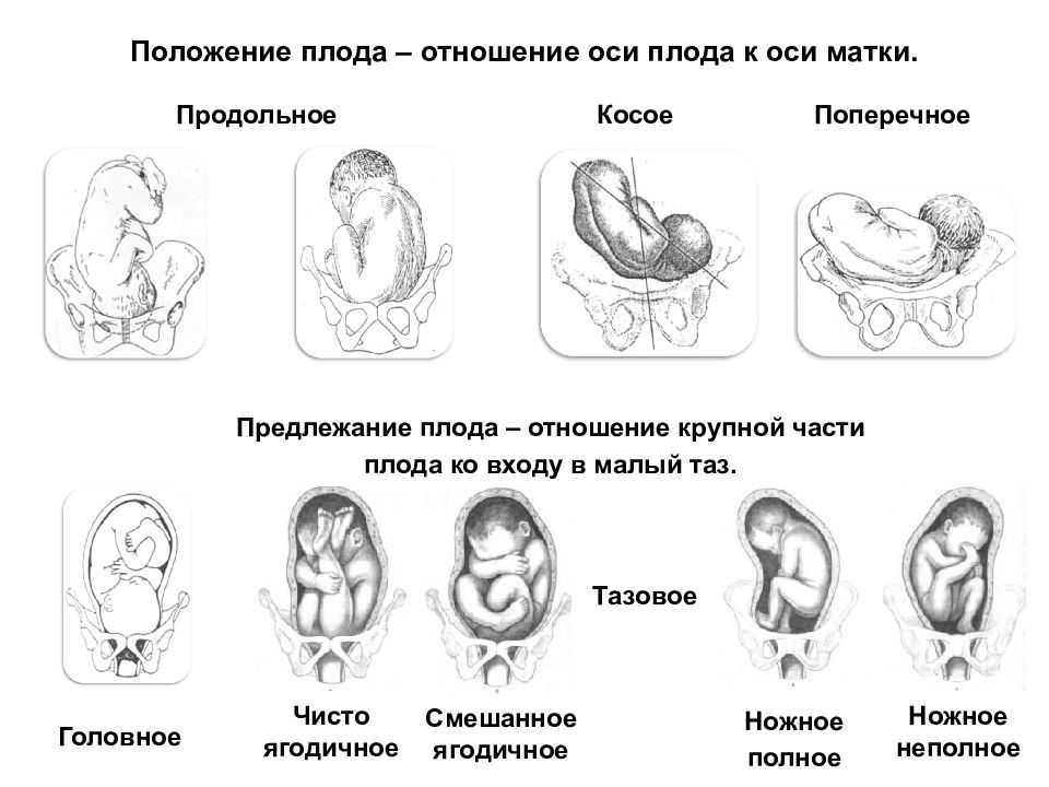 Ребенок расположен справа. Головное предлежание косое положение плода. Положение плода продольное головное 1 позиция. Положение продольное тазовое 2 позиция. Продольное головное предлежание плода 32 недели беременности.