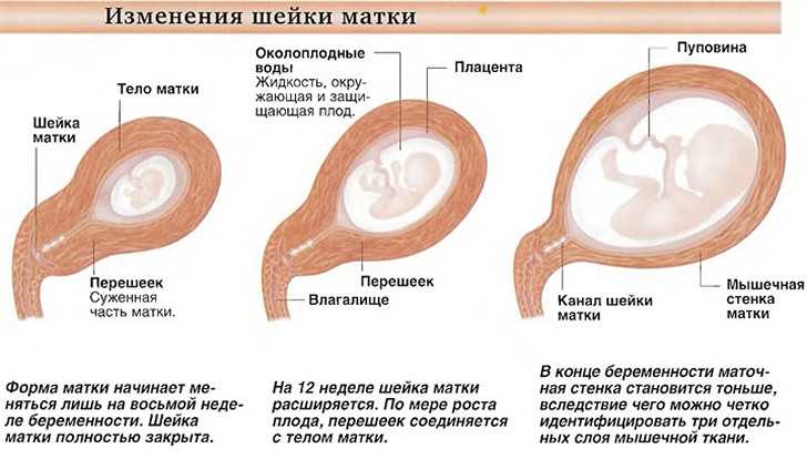 Опущение матки (выпадение) - степени 1, 2, 3 и 4, фото и лечение