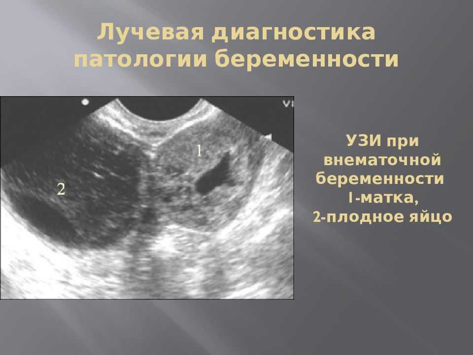 Когда на узи видно беременность на ранних. Внематочная Трубная беременность УЗИ. Внематочная беременность на УЗИ. Внематочнаябкременность УЗИ. УЗИ при внематочной беременности.