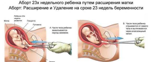 Медикаментозный аборт
 - vmc verte medical clinic