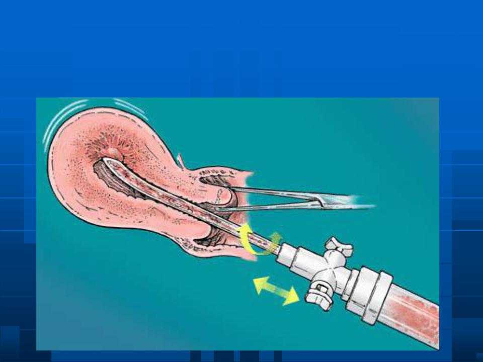Контроль полости матки. Вакуум-аспирация эндометрия. Вакуум-аспирация полости матки инструменты. Аспирационная биопсия эндометрия. Вакуум аспирация содержимого полости матки.