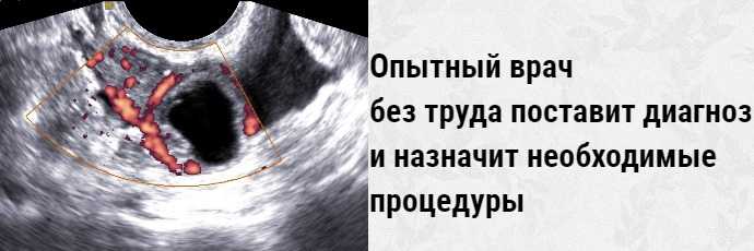 На узи видно внематочную. Внематочная беременность УЗИ признаки. Внематочная беременность на УЗИ. Внематочная беременность по УЗИ. Трубная беременность УЗИ.