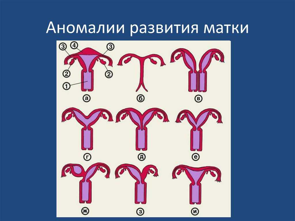 Аномалии положения женских органов презентация